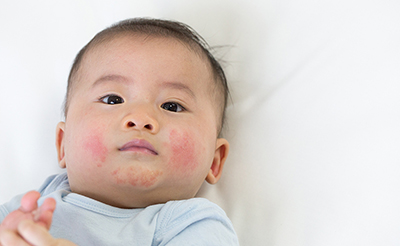 【小児科医監修】赤ちゃんの湿疹（ブツブツ）の種類と原因は？多い時期、家庭での対処法もご紹介