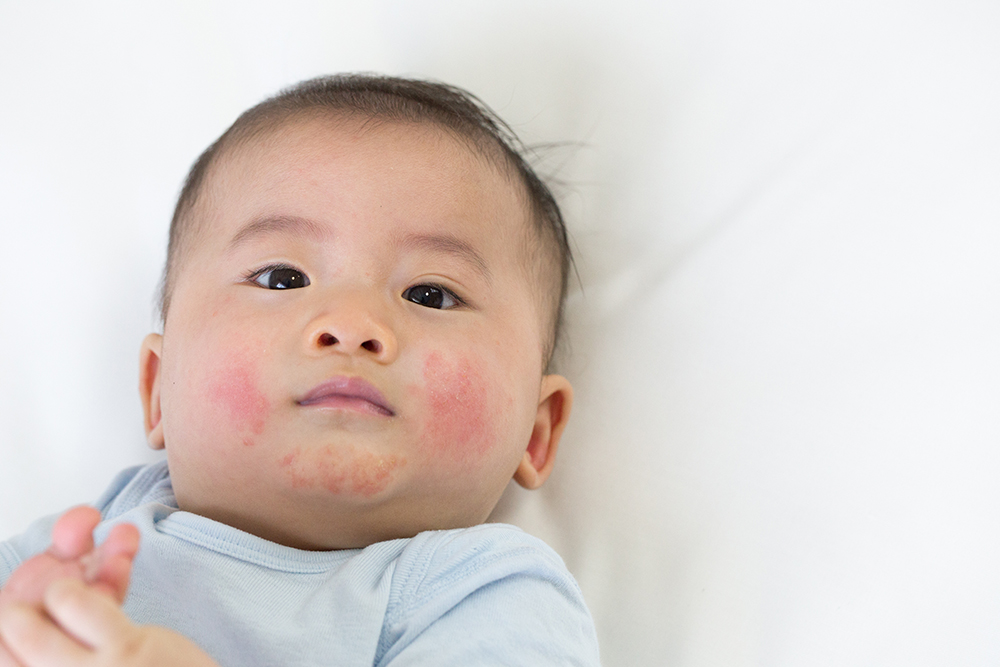 【小児科医監修】赤ちゃんの湿疹（ブツブツ）の種類と原因は？多い時期、家庭での対処法もご紹介