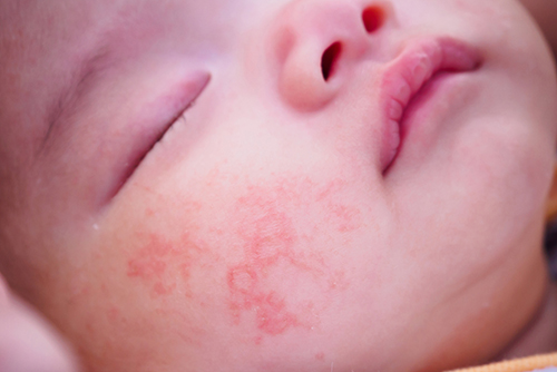 【種類別】赤ちゃんの湿疹ができやすい場所